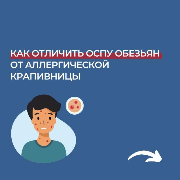 Как не перепутать оспу обезьян с аллергической реакцией? (инфографика)